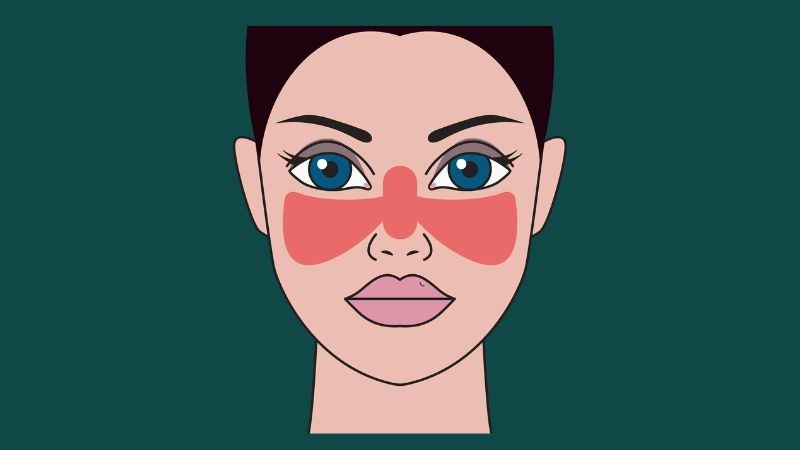 Hồng ban cánh bướm trên mặt bệnh nhân lupus