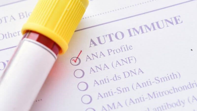 Test ANA giúp chẩn đoán lupus ban đỏ