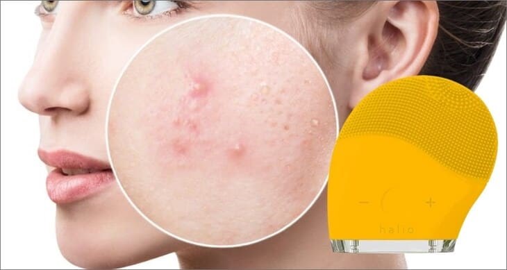 Nếu bạn bị mụn ẩn trước đó, độ rung của máy sẽ làm mụn vỡ ra và lan sang những vùng khác trên mặt