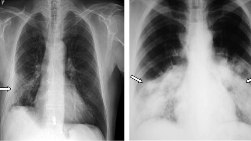 Hình ảnh tổn thương phổi hậu Covid-19 ở trẻ em