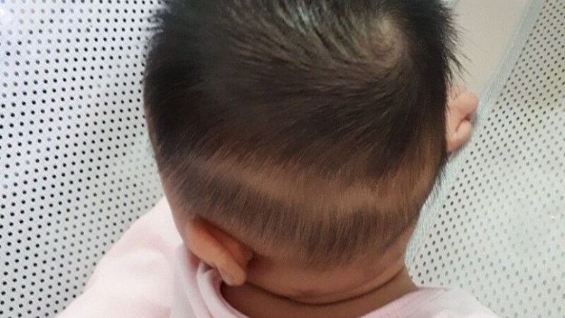 Rụng tóc là biến chứng da liễu ở trẻ mắc hậu Covid-19