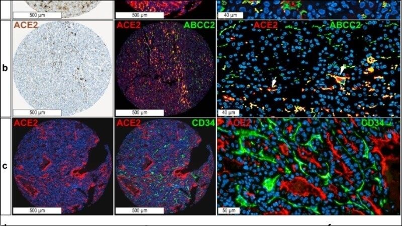 Mức độ biểu hiện ACE2 trên gan được điều chỉnh bởi nhiều yếu tố Mức độ biểu hiện ACE2 trên gan được điều chỉnh bởi nhiều yếu tố
