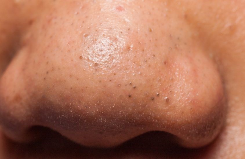 Mụn đầu đen li ti trên cánh mũi khiến bạn kém sắc