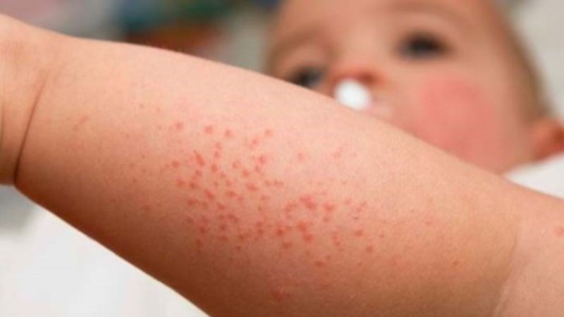 Sởi là một bệnh nhiễm trùng gây thiếu hụt vitamin A ở trẻ em