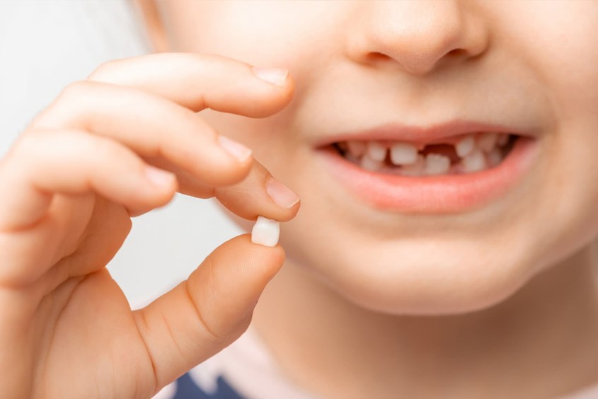 Răng sữa lung lay bao lâu thì nhổ? Cần lưu ý gì khi trẻ thay răng?