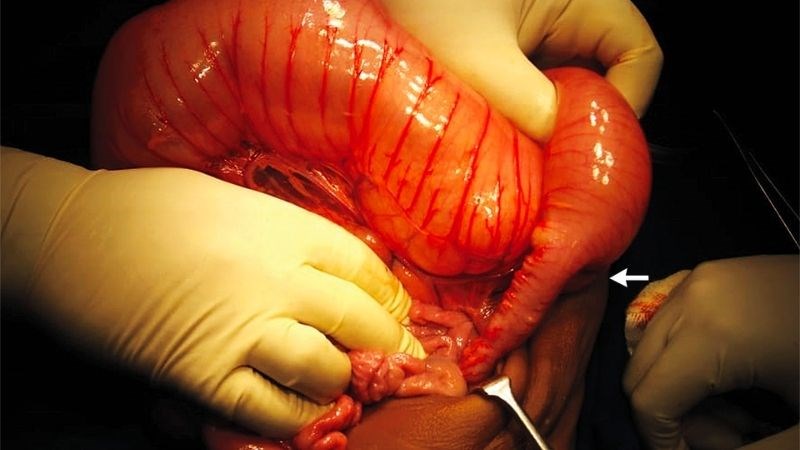 Phình đại tràng vô hạch bẩm sinh là một bệnh lý thường gặp ở trẻ em