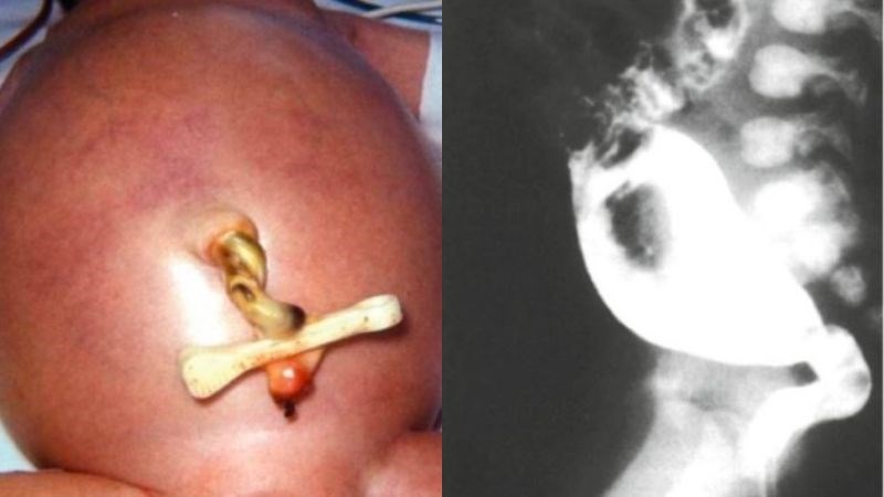 Tắc ruột là triệu chứng thường thấy ở trẻ phình đại tràng bẩm sinh