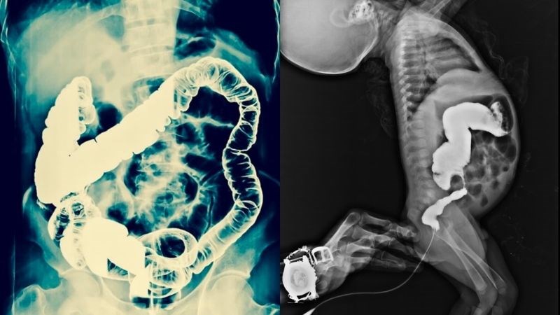 X quang bụng là cận lâm sàng có giá trị cao giúp bác sĩ chẩn đoán bệnh