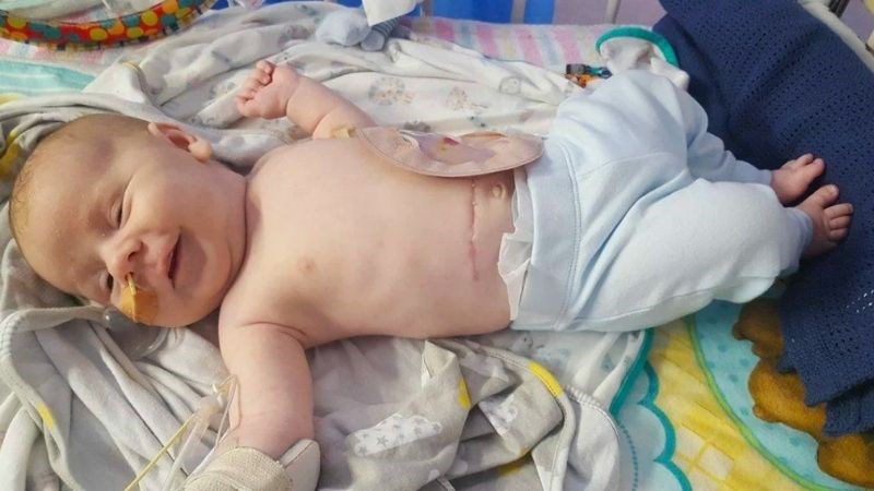 Phẫu thuật gần như là điều trị bắt buộc ở trẻ bị bệnh phình đại tràng bẩm sinh