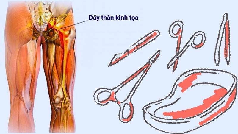 Phẫu thuật được chỉ định khi dây thần kinh tọa có nguy cơ tổn thương vĩnh viễn