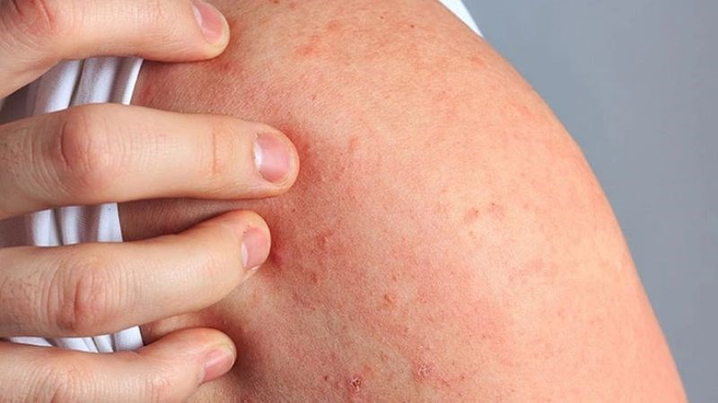 Nếu có dấu hiệu bất thường sau khi uống thuốc, bạn cần ngừng sử dụng thuốc ngay