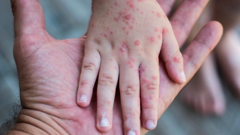 Cần hạn chế tiếp xúc với người bị bệnh để ngăn chặn sự lây lan