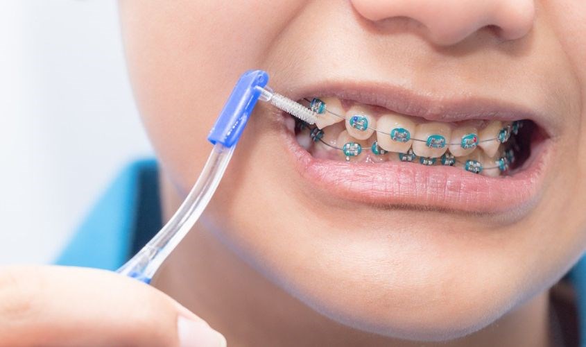 Bàn chải kẽ răng dành hco người niềng răng