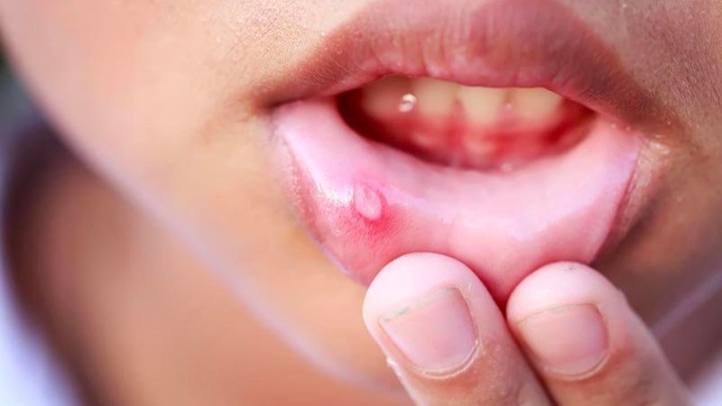 Vải có tính nhiệt, do đó không nên ăn quá nhiều