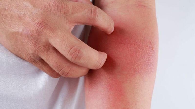 Vải giúp kiểm soát viêm 