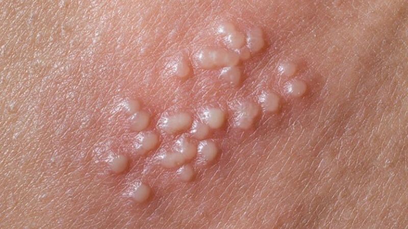 Vải giúp kháng vi-rút Herpes