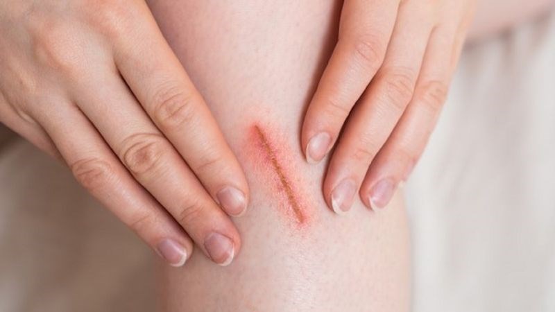 Các hoạt chất có trong chôm chôm giúp vết thương nhanh lành, chống nhiễm trùng