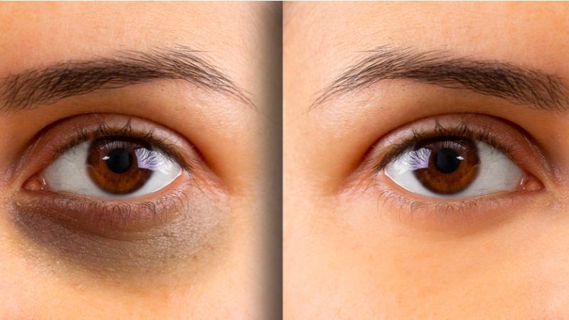 Glutathione và vitamin C có khả năng làm giảm quầng thâm mắt