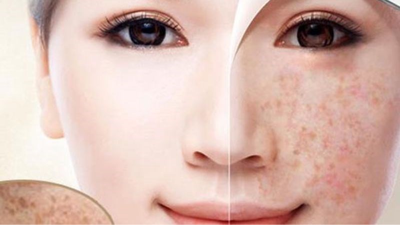 Glutathione và vitamin C giúp làm mờ vết thâm mụn, thâm nám và tàn nhang