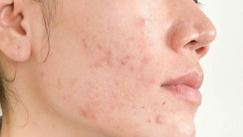 Glutathione và vitamin C giúp hạn chế tình trạng nhiễm trùng gây viêm