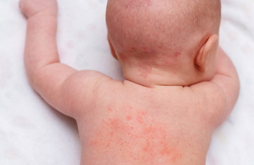 Da bé sẽ bị nổi mẩn đỏ khi dị ứng nước giặt 