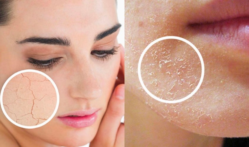 Da khô thường xuất hiện tình trạng bong tróc vảy