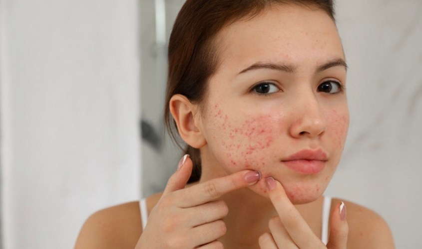 Bạn cần tìm các loại mặt nạ dành cho da mụn giúp giảm dầu và các tế bào chết