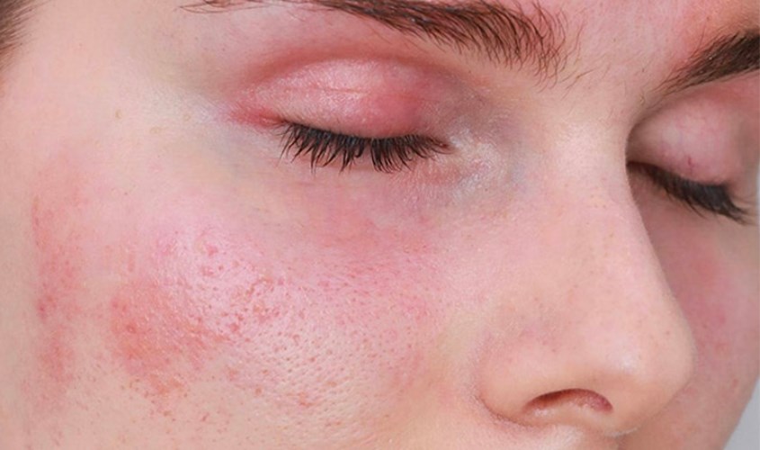 Da nhạy cảm là loại da rất dễ bị nổi mẩn đỏ, kích ứng hoặc ngứa, nóng da