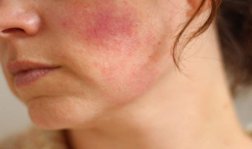 Da bị khô, mẩn đỏ và kích ứng Da bị khô, mẩn đỏ và kích ứng