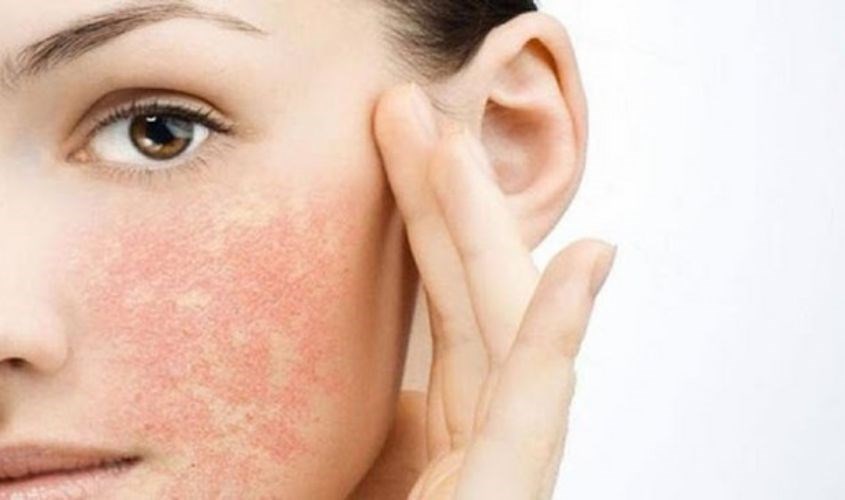 Da bị ngứa rát Da bị ngứa rát