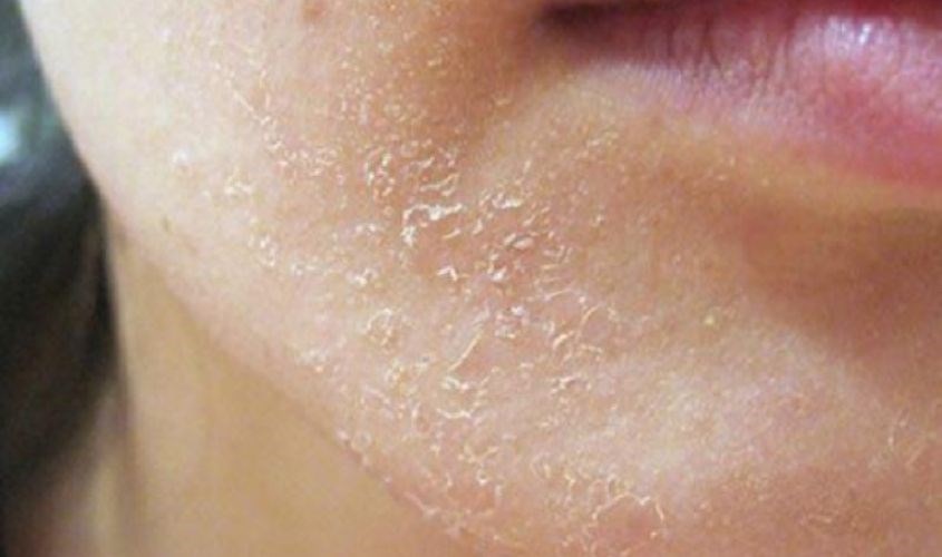 Da bị bong tróc Da bị bong tróc