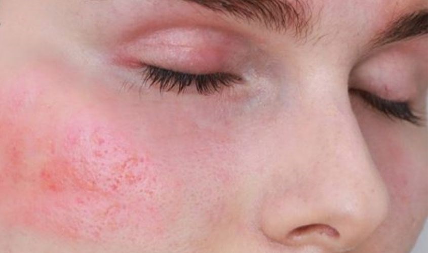 Vùng mắt bị kích ứng Vùng mắt bị kích ứng