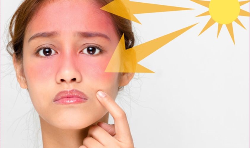 Da nhạy cảm hơn với ánh nắng mặt trời Da nhạy cảm hơn với ánh nắng mặt trời
