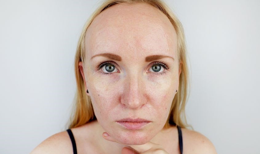 Đối với da dầu, bị mụn thì nên dùng tẩy tế bào chết có chứa BHA Đối với da dầu, bị mụn thì nên dùng tẩy tế bào chết có chứa BHA