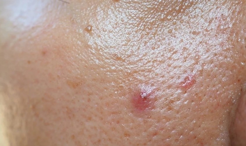 Da dầu mụn thường bị bóng nhờn quá mức