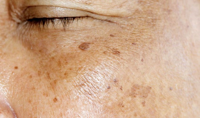 Tàn nhang và đồi mồi xuất hiện do sự thay đổi nội tiết tố trong cơ thể 