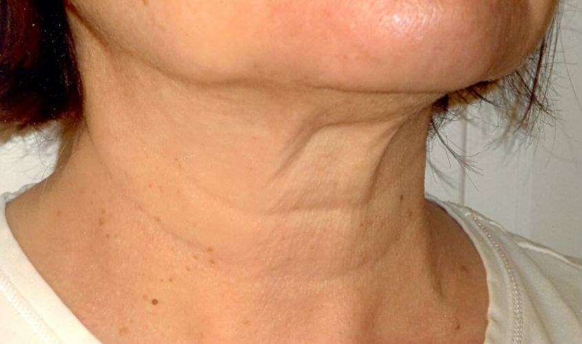 Da bị chảy xệ do các collagen không đủ làm da căng bóng