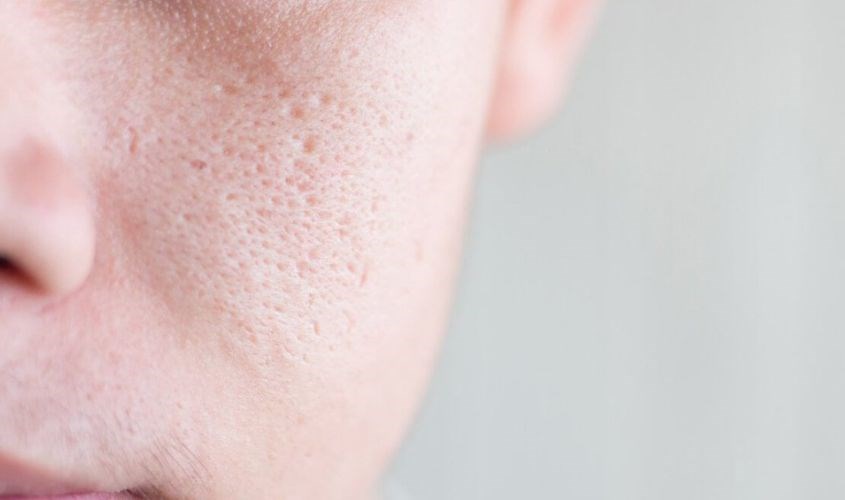 Lượng hormone trong cơ thể tụt giảm khiến các lỗ chân lông hiện ra rõ rệt