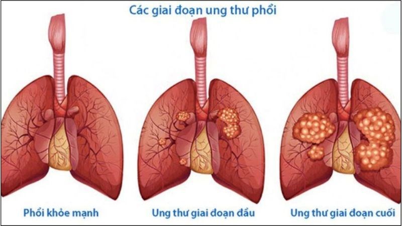 Ung thư phổi được chia thành 4 giai đoạn