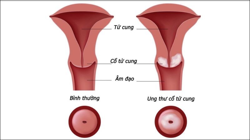 Ung thư cổ tử cung xảy ra khi các tế bào phát triển bất thường, hình thành khối u