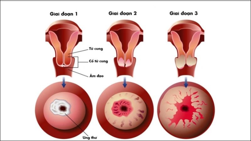 Tầm soát ung thư cổ tử cung giúp phát hiện bệnh sớm để điều trị và giảm tử vong