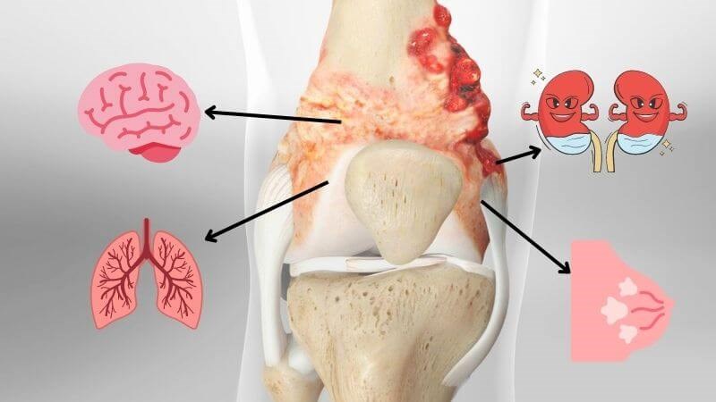 Ung thư xương nguy hiểm vì dễ di căn sang bộ phận khác