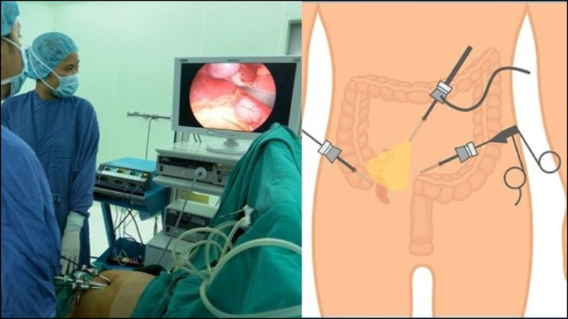 Phương pháp phẫu thuật nội soi và phẫu thuật mổ mở trong điều trị viêm ruột thừa cấp. Phương pháp phẫu thuật nội soi và phẫu thuật mổ mở trong điều trị viêm ruột thừa cấp.