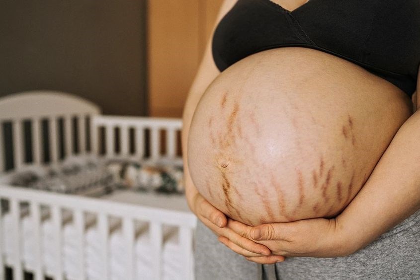 Hình ảnh bụng mẹ bị rạn do da căng quá mức Hình ảnh bụng mẹ bị rạn do da căng quá mức