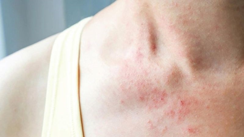Dị ứng tinh dịch ở nữ giới có các dấu hiệu như đỏ ngứa, bỏng rát, phù nề