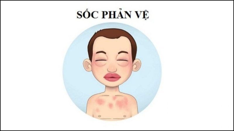 Biến chứng nguy hiểm nhất của dị ứng tinh dịch là sốc phản vệ