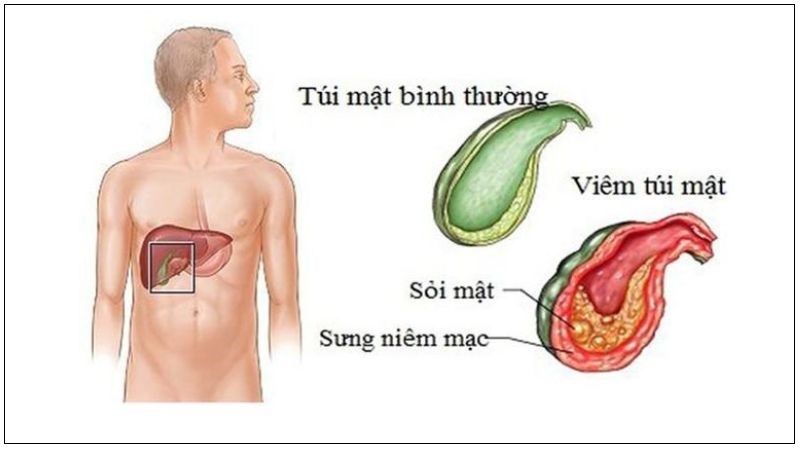 Nhân trần giúp hỗ trợ điều trị viêm túi mật.