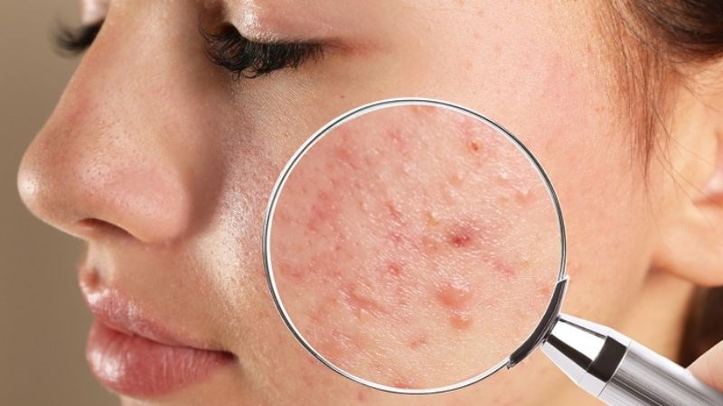 Nhân trần có khả năng thanh lọc cơ thể, ngăn ngừa và hỗ trợ điều trị mụn.