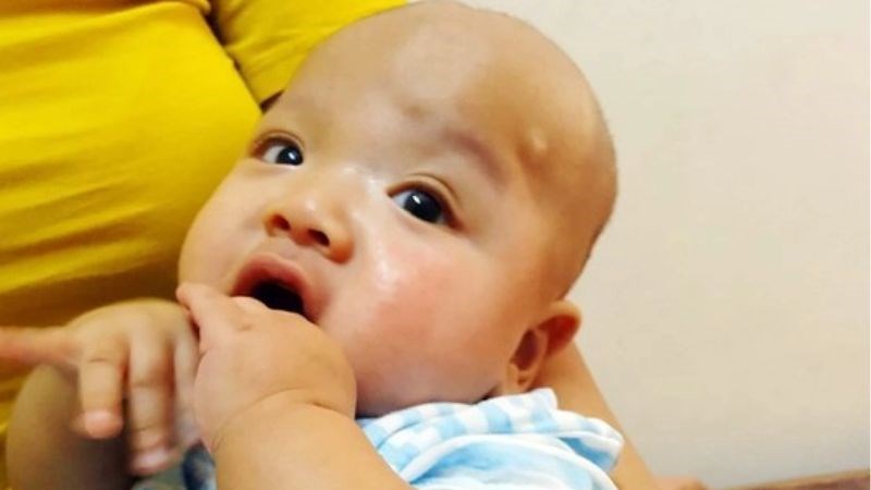 Não úng thủy nếu được phát hiện và điều trị kịp thời sẽ giảm tỷ lệ tử vong