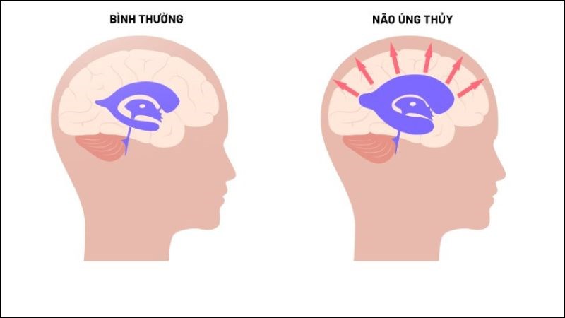 Não úng thủy là tình trạng dịch não tủy nhiều hơn bình thường chèn ép nhu mô não